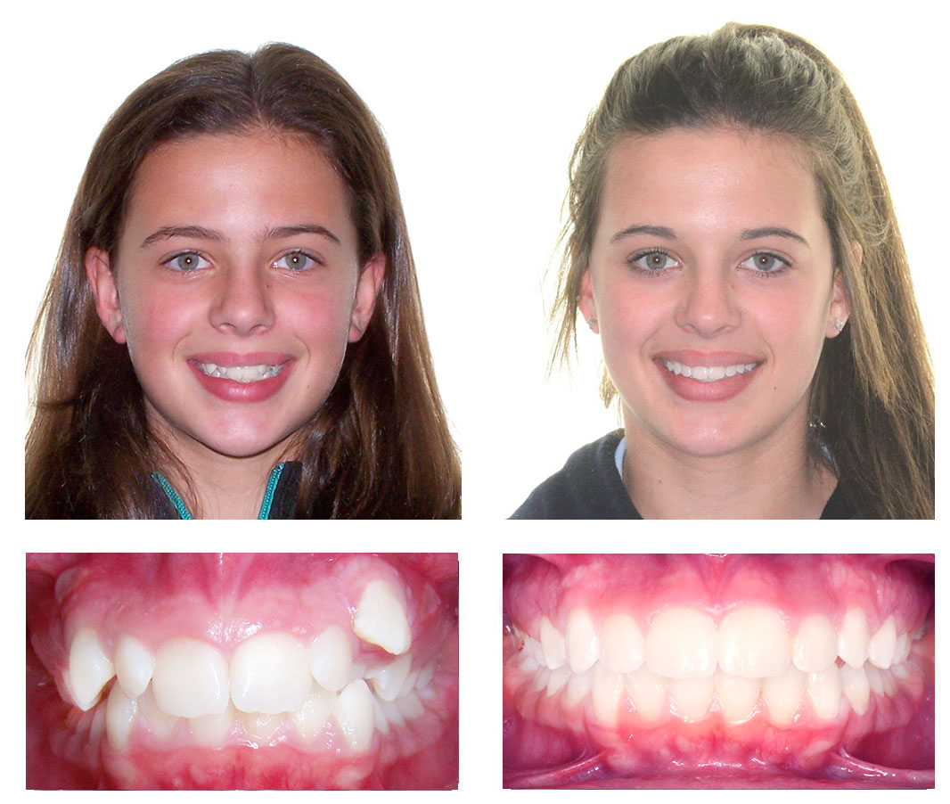 зубы до и после ношения брекетов