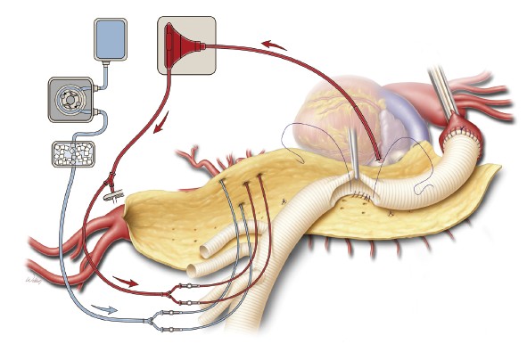 имплантация межреберных артерий