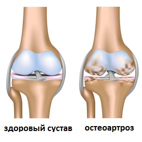 артроз коленного сустава