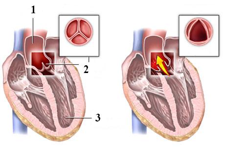 аортальный клапан в норме