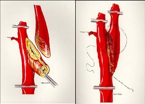 имплантация внутренней сонной артерии в старое устье