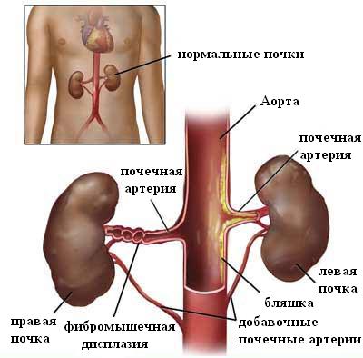 причины сужений почечных артерий при ВРГ