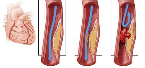 схема развития тромбоза коронарной артерии и острого коронарного синдрома