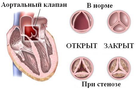 Аортальный стеноз