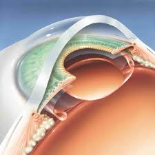 операция при катаракте