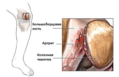 воспаление оболочек суставной сумки при артрите