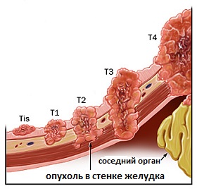стадии рака желудка по классификации TNM