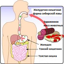 желудочно-кишечная форма сибирской язвы