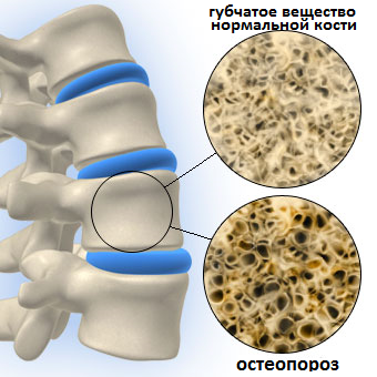 остеопороз и менопауза