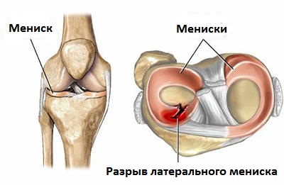 разрыв латерального мениска коленного сустава
