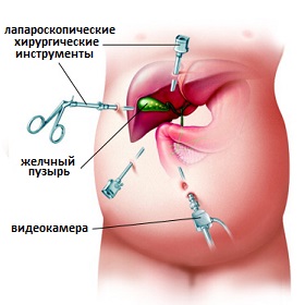 лапароскопическая холецистэктомия