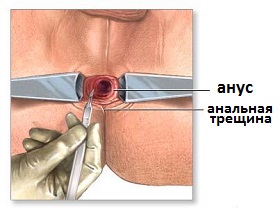 операция иссечения трещины прямой кишки