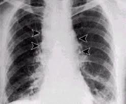 рентгенограмма при сибирской язве