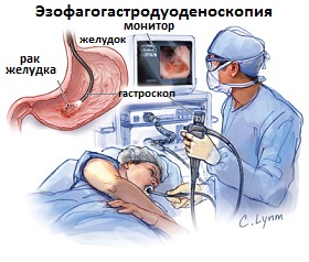 гастроскопия при раке желудка