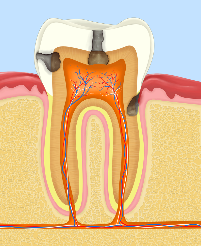 кариес зуба типичные места