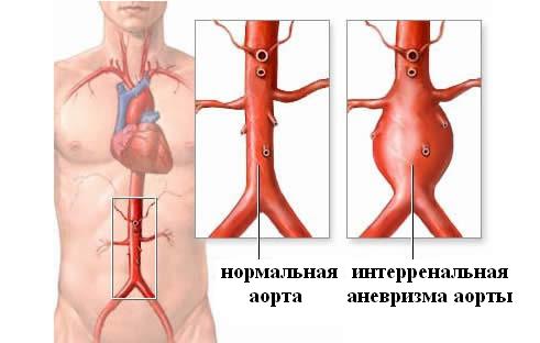 интерренальная аневризма брюшной аорты