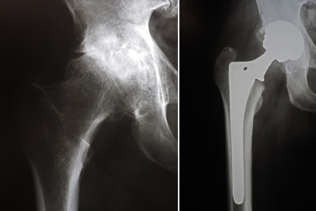Рентгенография сустава до и после эндопротезирования