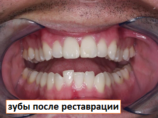 зубы после реставрации
