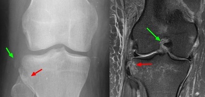 рентген и МРТ при травме колена