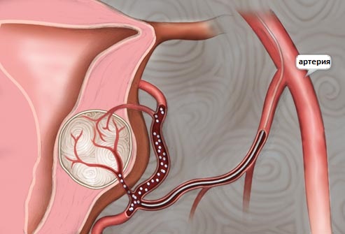 эмболизация маточных артерий при миоме и маточном кровотечении