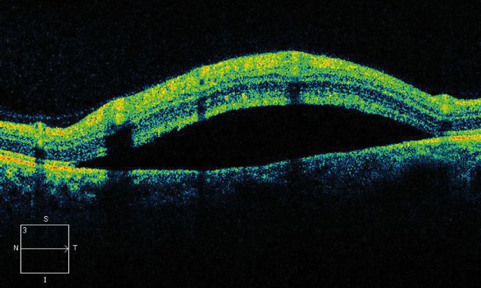 оптическая когерентная томография при отслойке сетчатки глаза