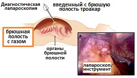 лапароскопия при раке желудка