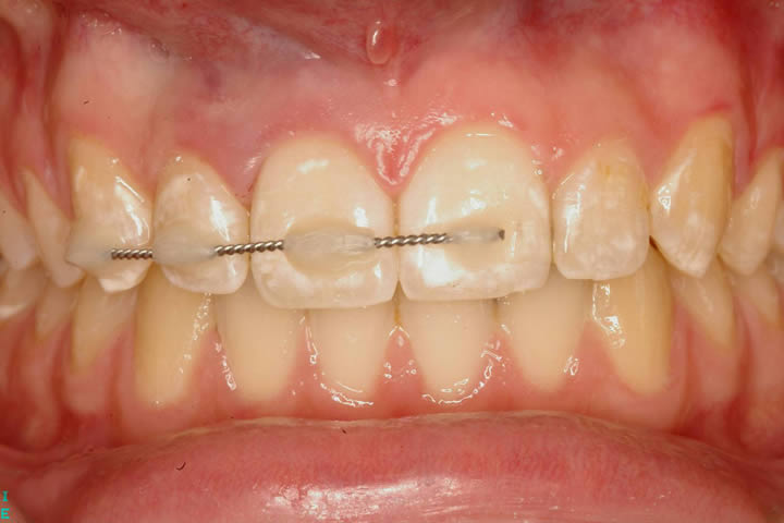 шинирование при травме зубов