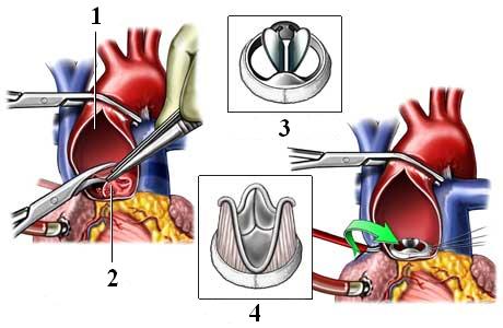 протезирование аортального клапана при эндокардите