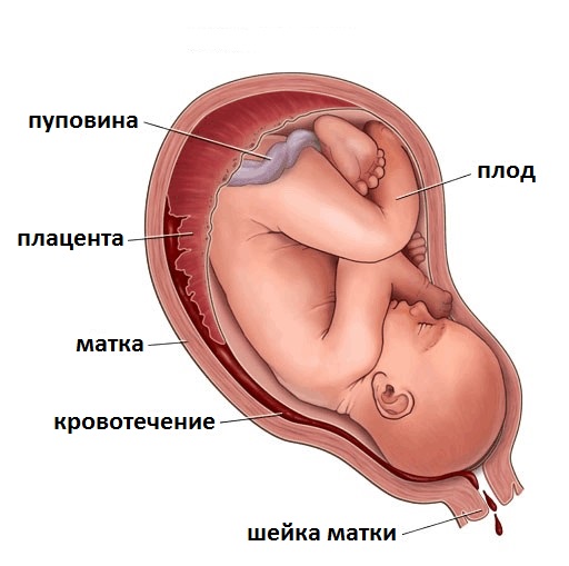 маточное кровотечение при беременности