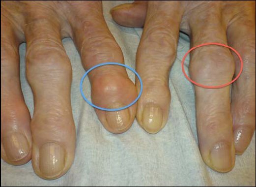 пальцы при остеоартрозе