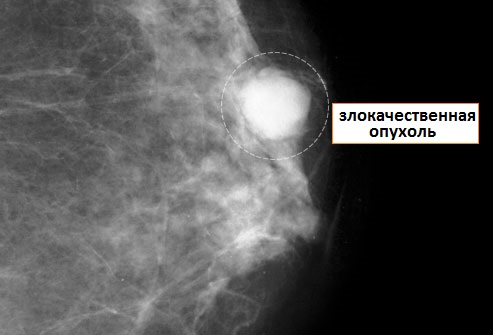 маммограмма при раке груди
