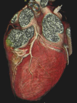 кт сердца или кт-коронарография