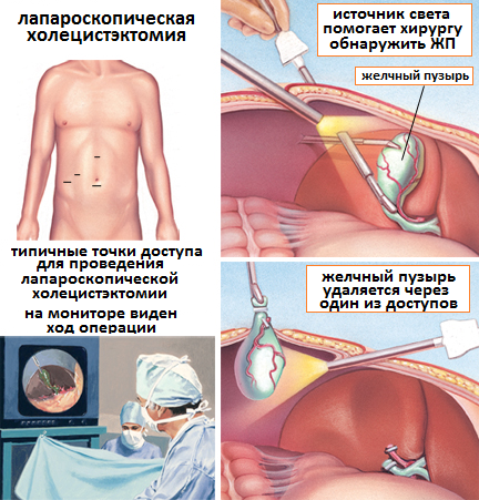 лапароскопическая холецистэктомия этапы операции
