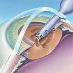 факоэмульсификация при операции по удалению катаракты