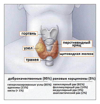 виды узлов в щитовидной железе