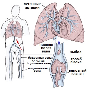 тромбоэмболия легочной артерии