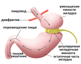 схема операции бандажирования желудка