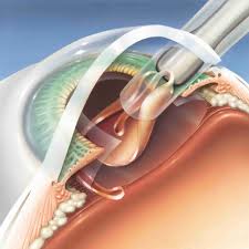 установка искусственной линзы при катаракте