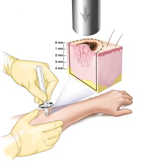 тонкосрезовая биопсия кожи или панч-биопсия