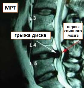 МРТ позвоночника при грыже межпозвоночного диска