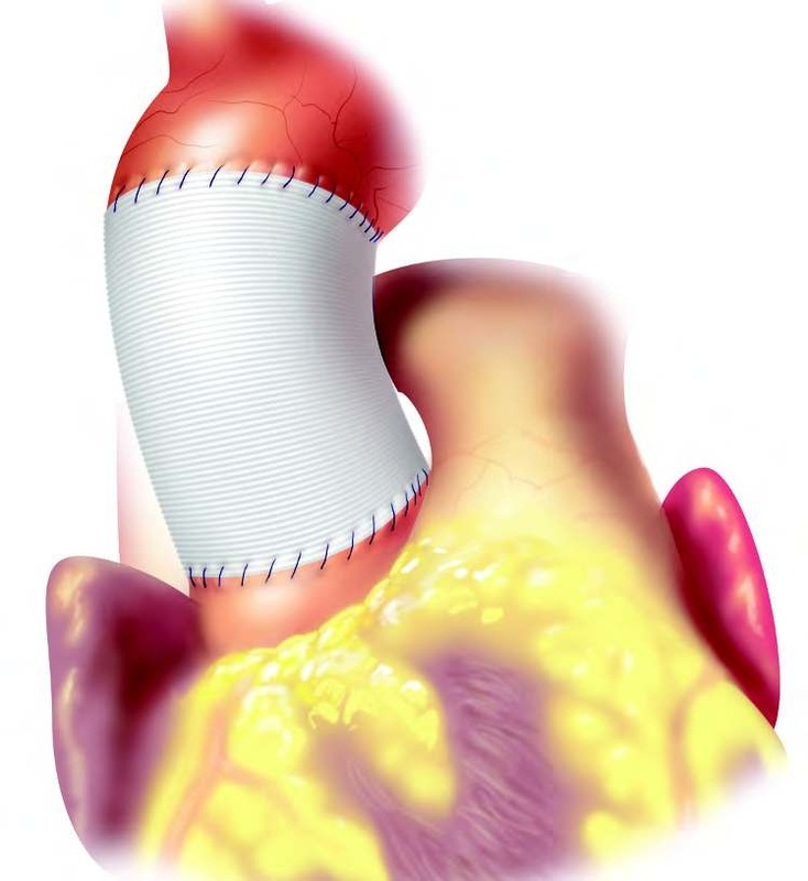 супракоронарное протезирование восходящей аорты
