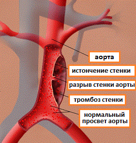 аневризма брюшной аорты
