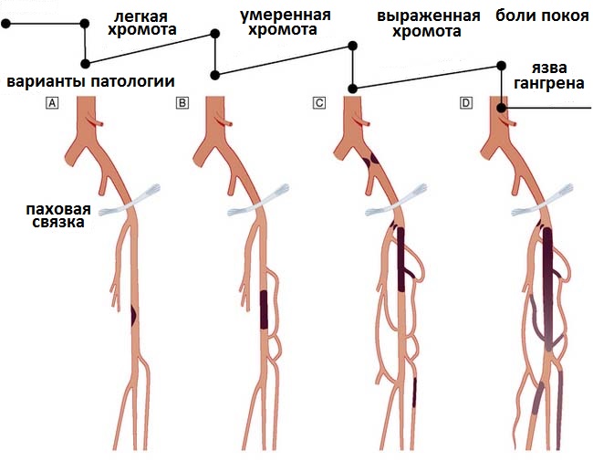 симптомы хромоты при разных уровнях и характере поражения сосудов - Симптом ИНФО