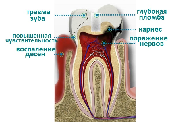 причины зубной боли