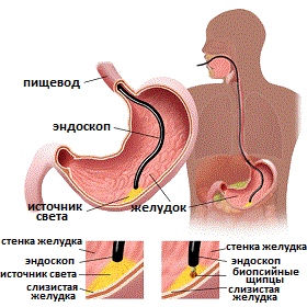 эзофагогастроскопия с биопсией слизистой желудка