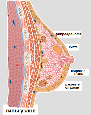 типы узлов молочной железы