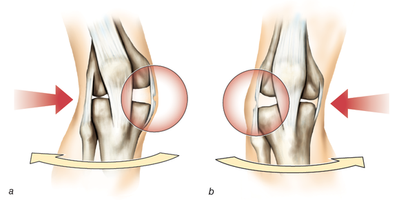 механизм деформации коленного сустава при травме