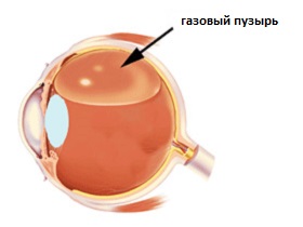 пневматическая ретинопексия
