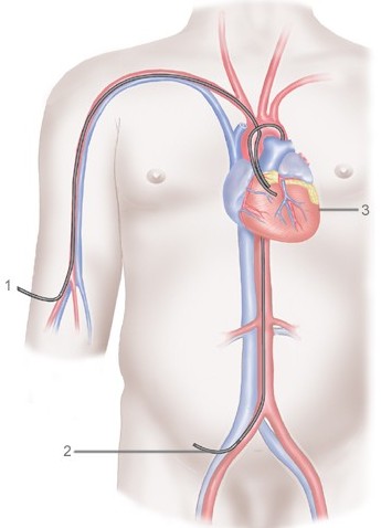 места катетеризации артерий при ангиографии